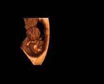 التراساوند ثلاثي الابعاد لجنين في الثلث الاول من الحمل 1
