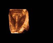 3D Ultrasound of Intrauterine Contraceptive Device