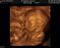 3D Second Trimester Ultrasound Scan Photos Slide Show