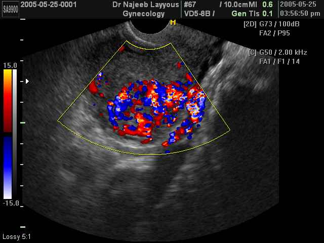 Invasive Mole (Post D&C) Doppler