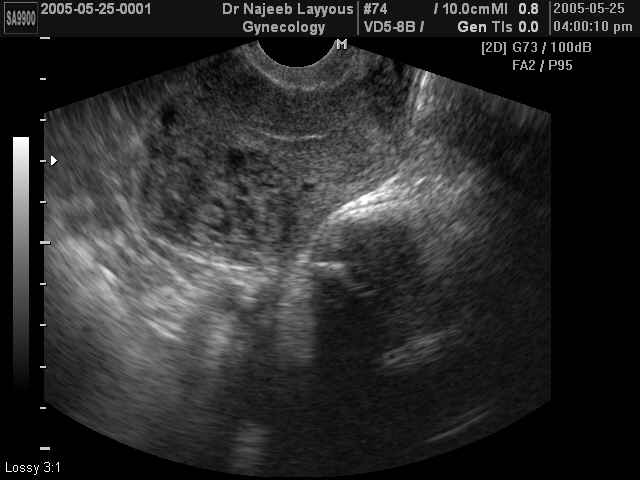 Invasive Mole (Post D&C)