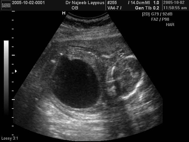 Obstructive Uropathy (large Bladder)