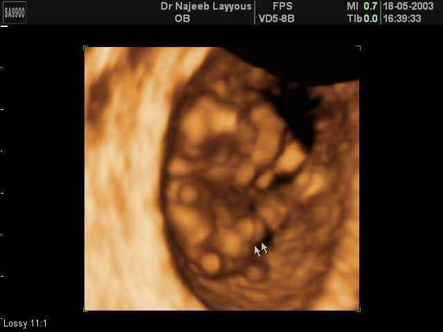 Physiological Umbilical Hernia