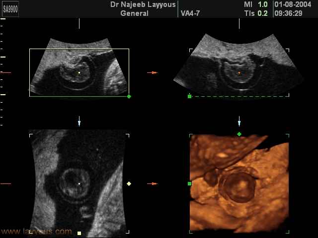 Placental Chorioangioma