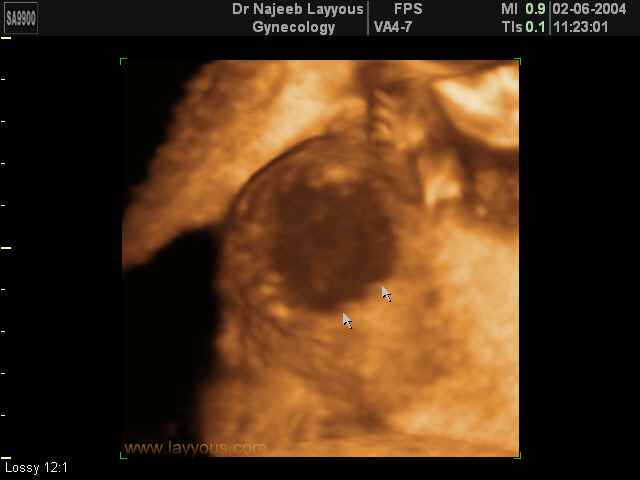 Placental Infarction