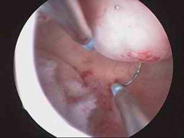 hysteroscopic myomectomy