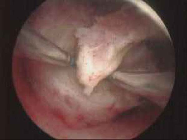 hysteroscopic myomectomy