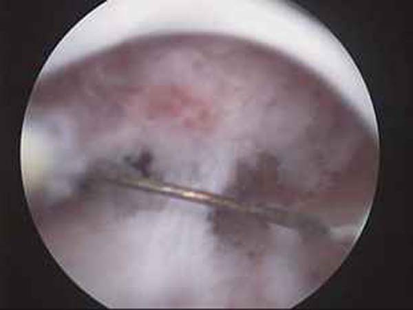 intrauterine adhesions