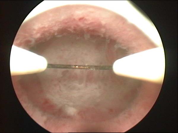 resection of uterine septum completed