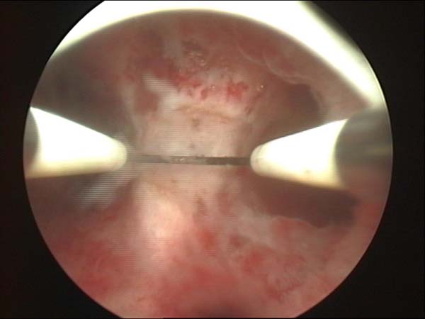 resection of uterine septum