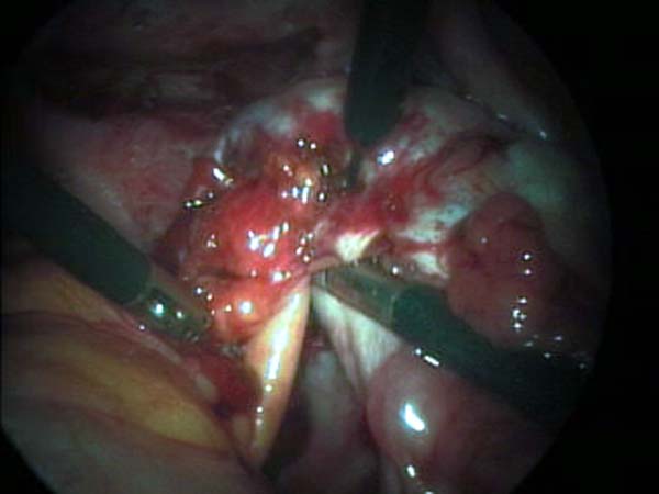 Adhesiolysis