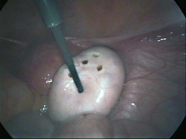 drilling of polycystic ovary