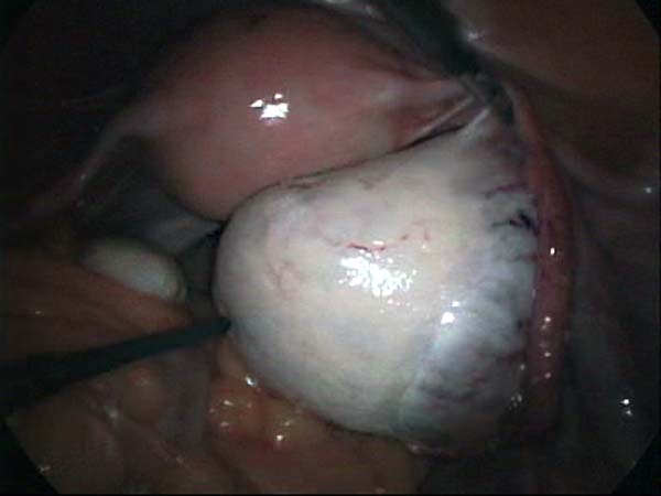 ovarian cyst