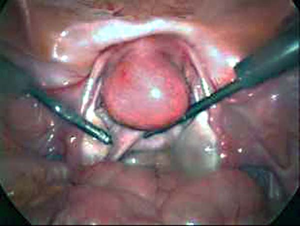 uterine fibroid