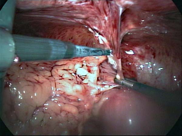 adhesiolysis