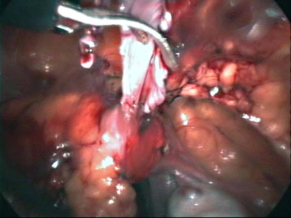 adhesiolysis