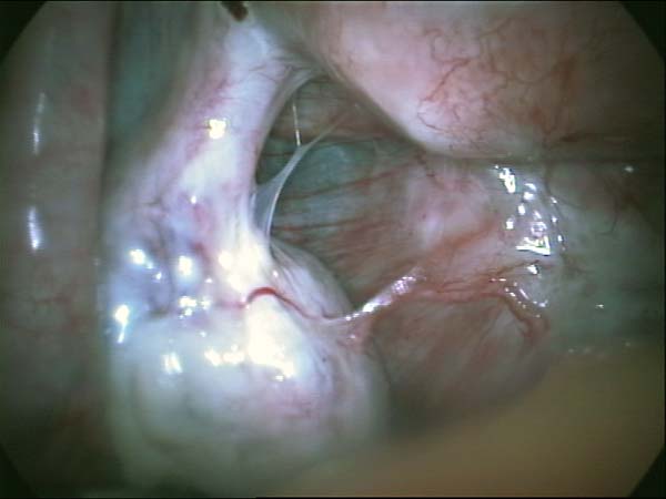 ovarian adhesions