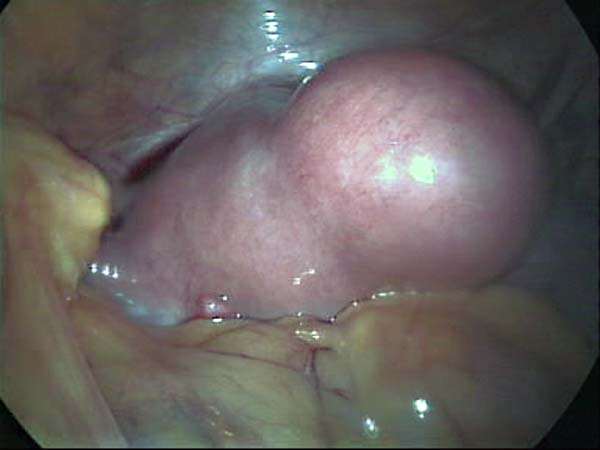 Uterine fibroid