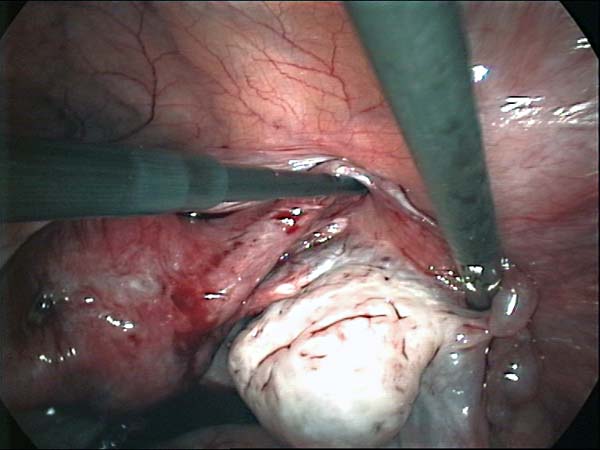 dissecting tubo ovarian adhesions