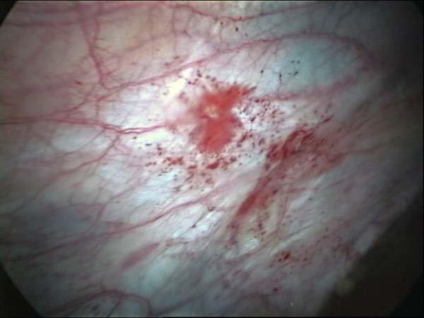 endometriotic spots