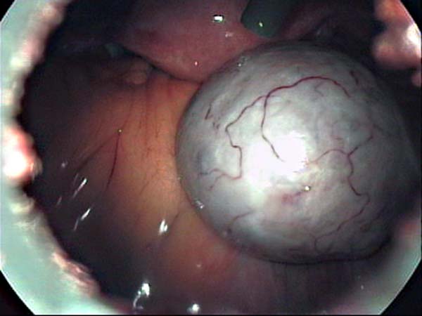 ovarian cyst