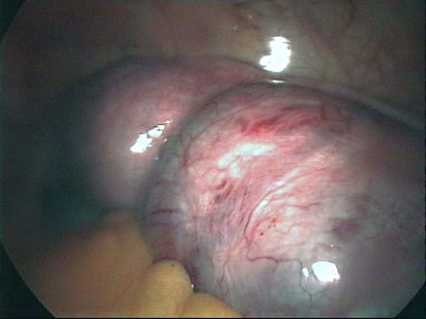 ovarian cyst