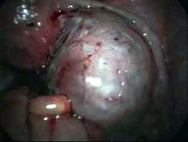 ovarian cyst