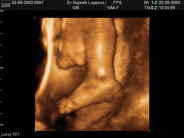 Fetal Foot