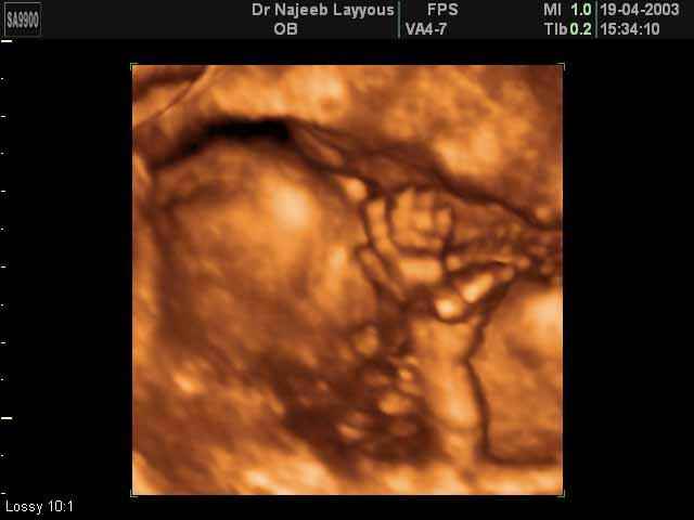 Fetal Hand 14 weeks