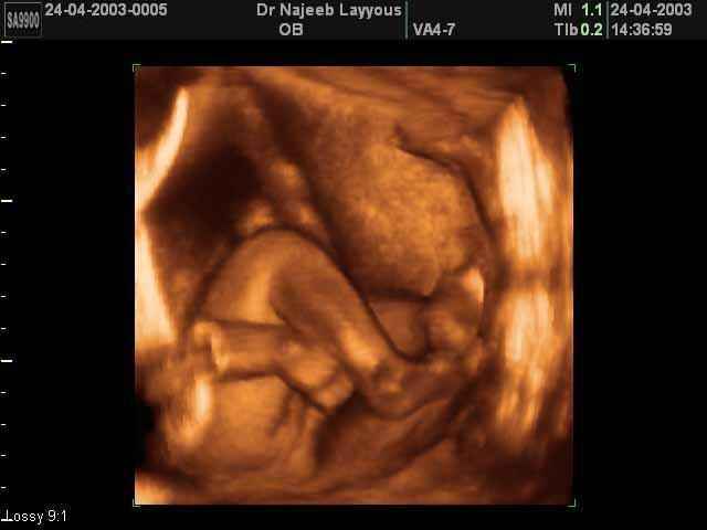 Lower limb and arm 27 weeks