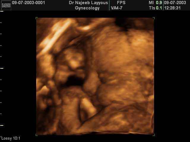 fetal profile