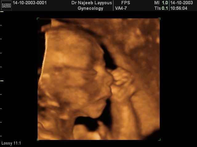 fetal profile