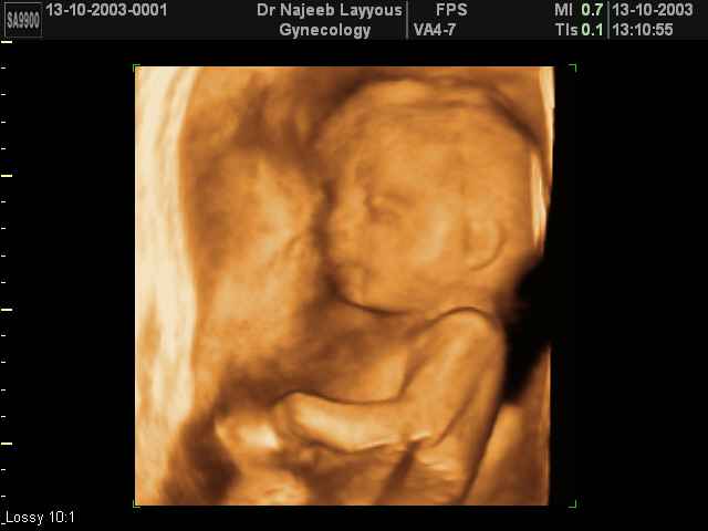 fetal profile