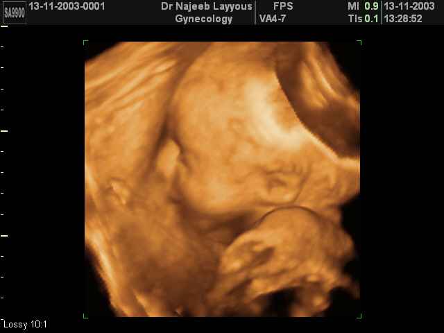 fetal profile