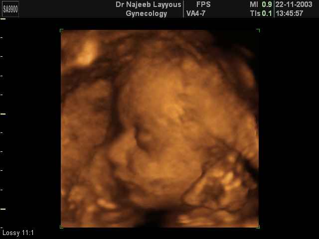 fetal profile