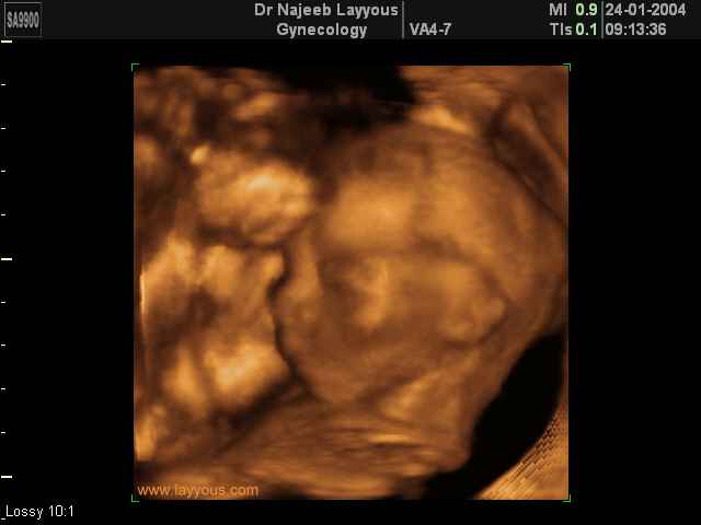 fetal profile