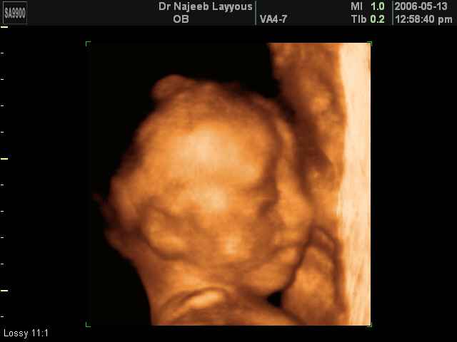 fetal profile