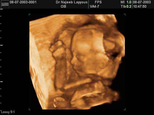 fetal profile