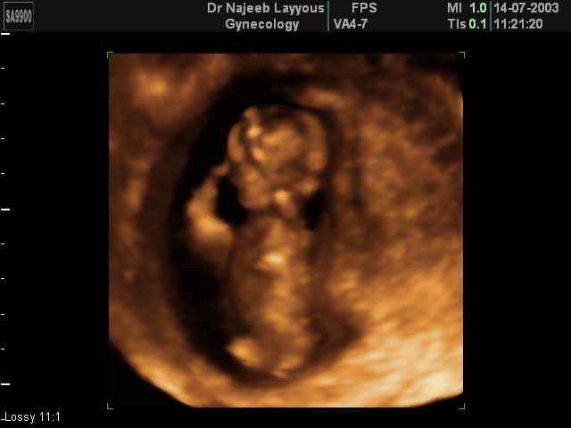 First Trimester Photos