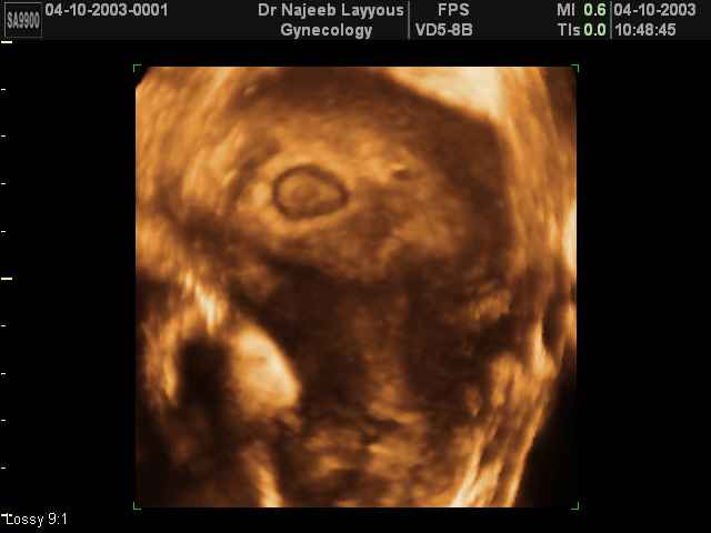 First Trimester Photos