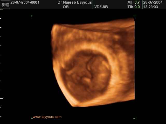 First Trimester Photos