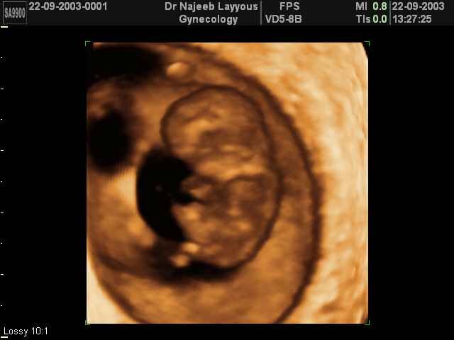 First Trimester Photos