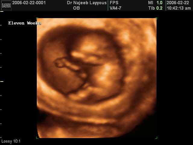 First Trimester Photos