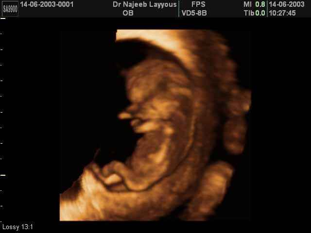 First Trimester Photos