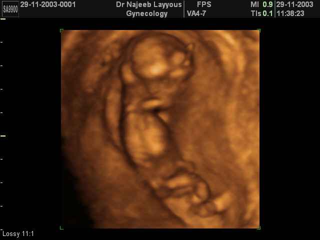 First Trimester Photos