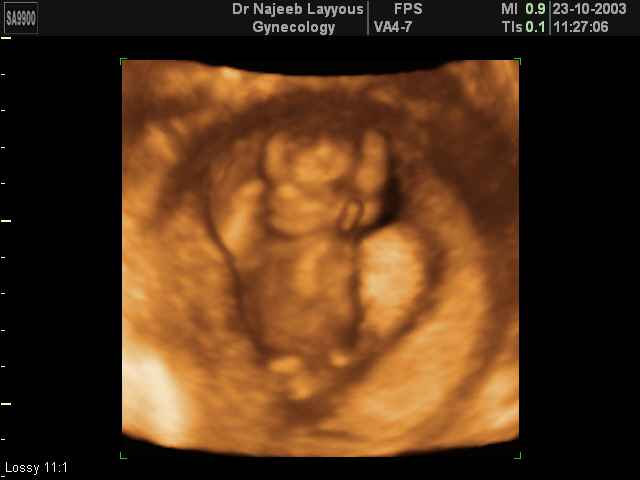 First Trimester Photos