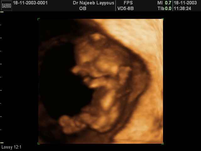 First Trimester Photos