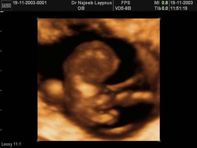 First Trimester Photos