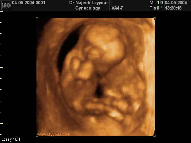 First Trimester Photos