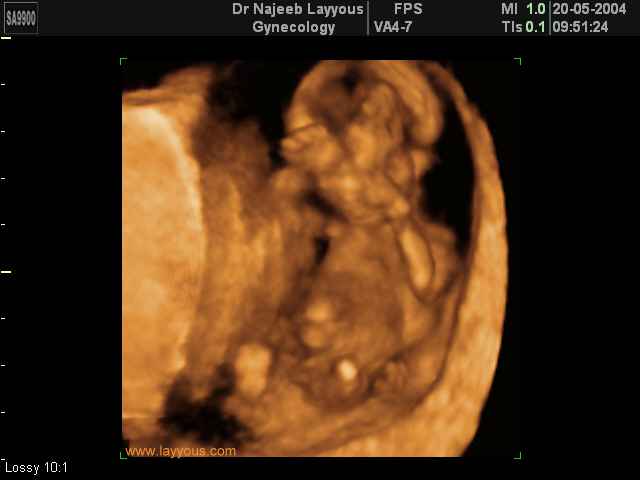 First Trimester Photos